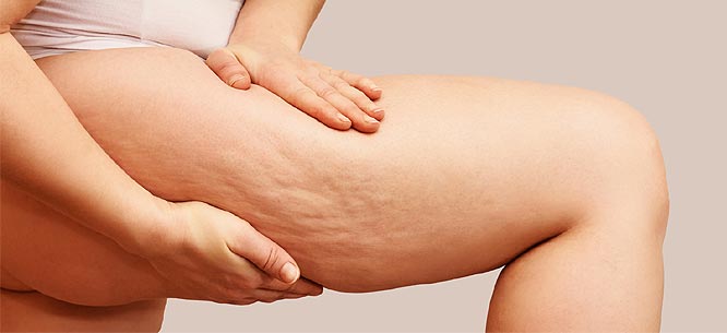 Lutter contre la cellulite avec l'aloe vera